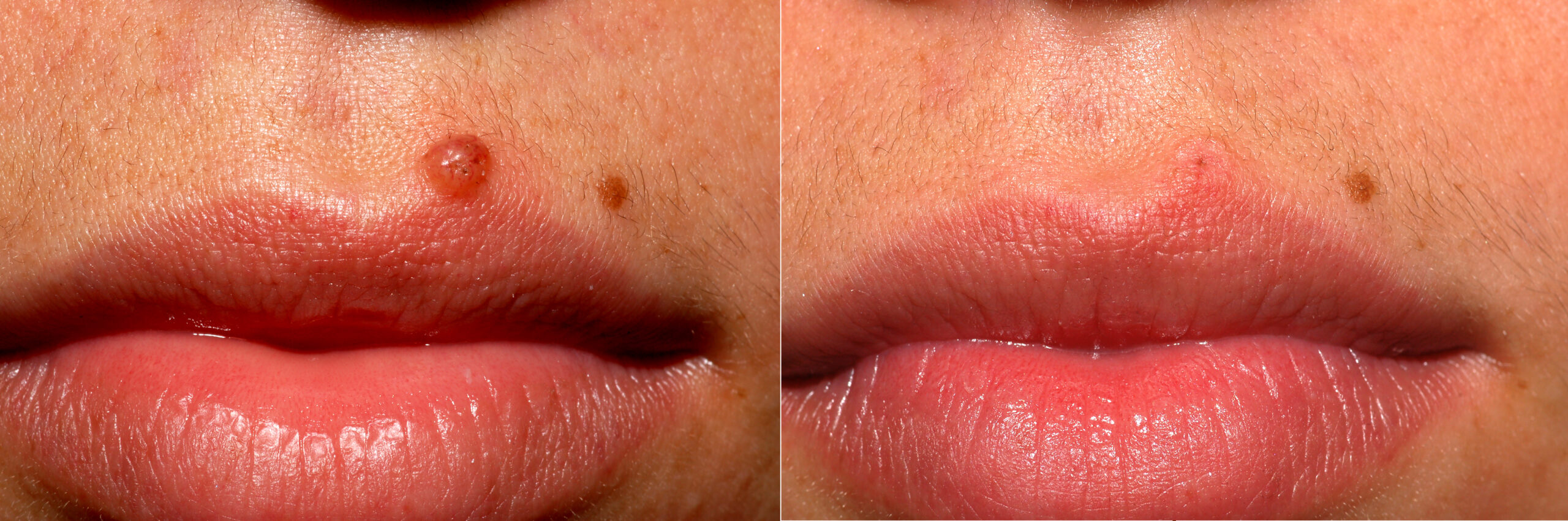 Remove Moles Scars With A Non Invasive Mole Removal Surgery