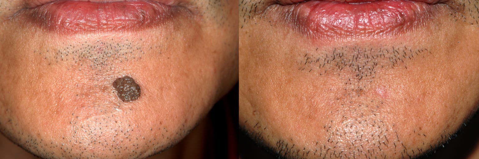 Remove Moles & Scars with a NonInvasive Mole Removal Surgery Remove Moles & Scars with a NonInvasive Mole Removal Surgery
