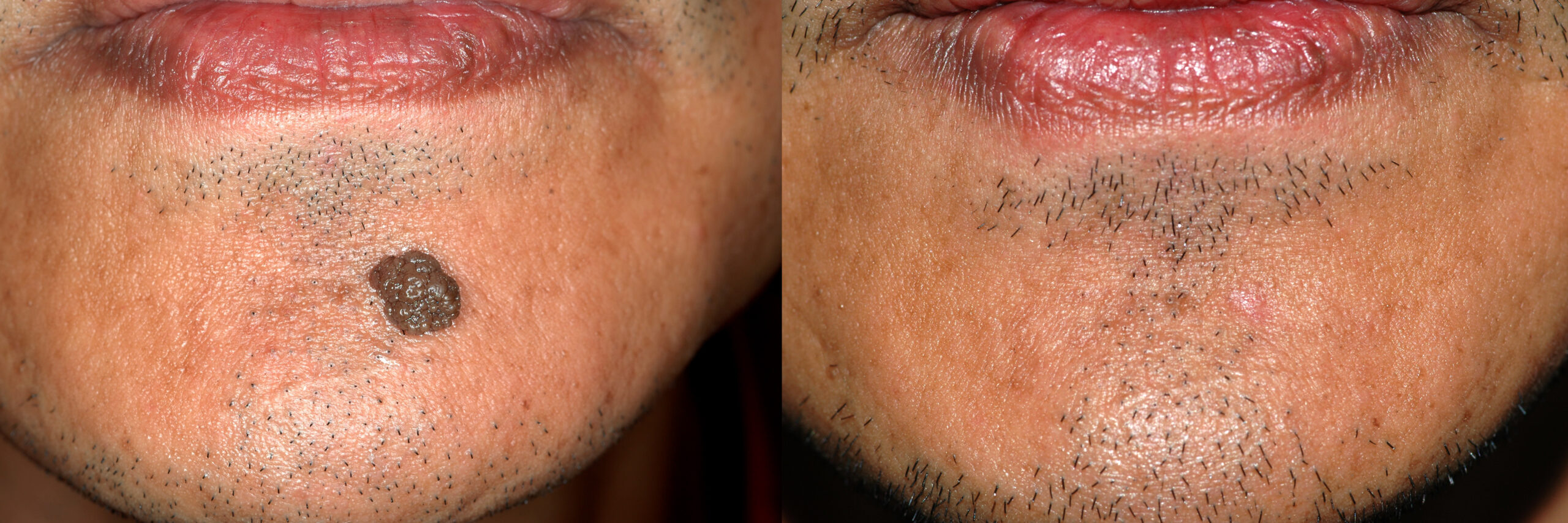 Raul pre RF mole removal Collage Hi Res scaled